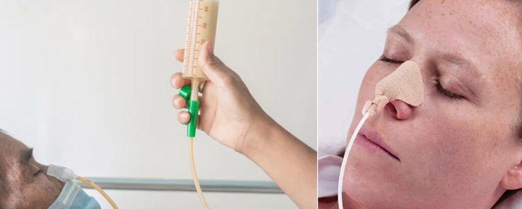 ryles-tube-insertion-at-home-in-gurgaon